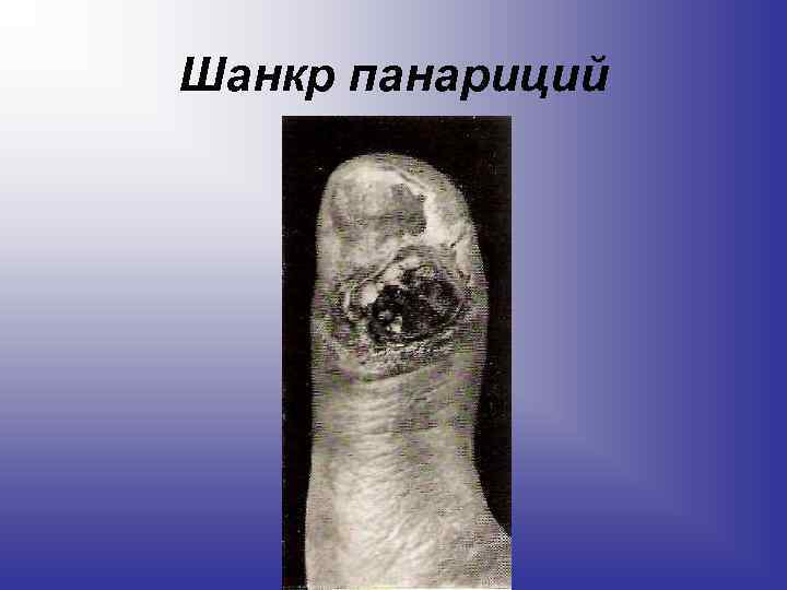 Шанкр панариций 