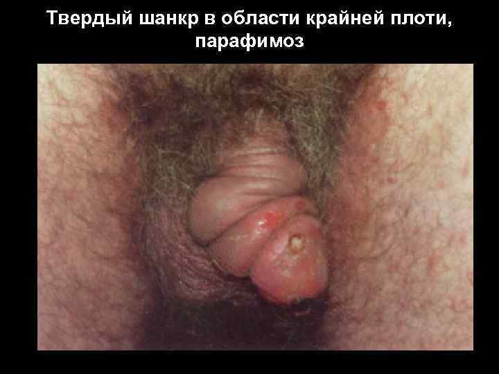 Твердый шанкр в области крайней плоти, парафимоз 