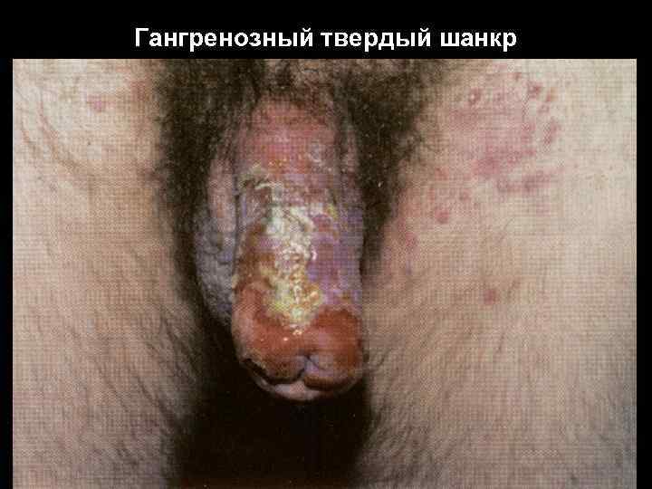 Гангренозный твердый шанкр 