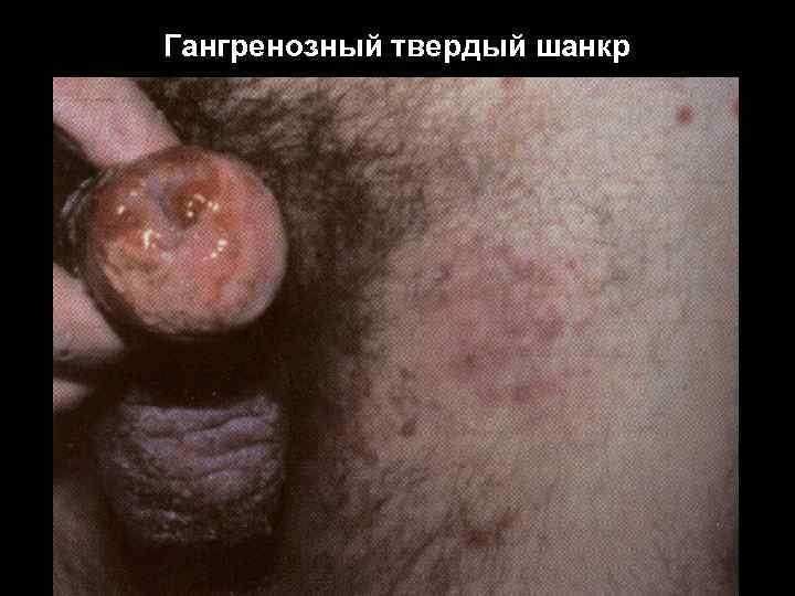 Гангренозный твердый шанкр 