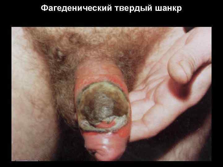Фагеденический твердый шанкр 