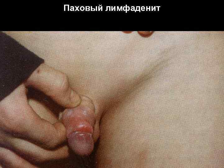 Паховый лимфаденит 