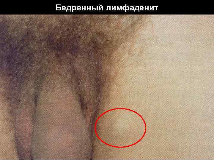 Бедренный лимфаденит 