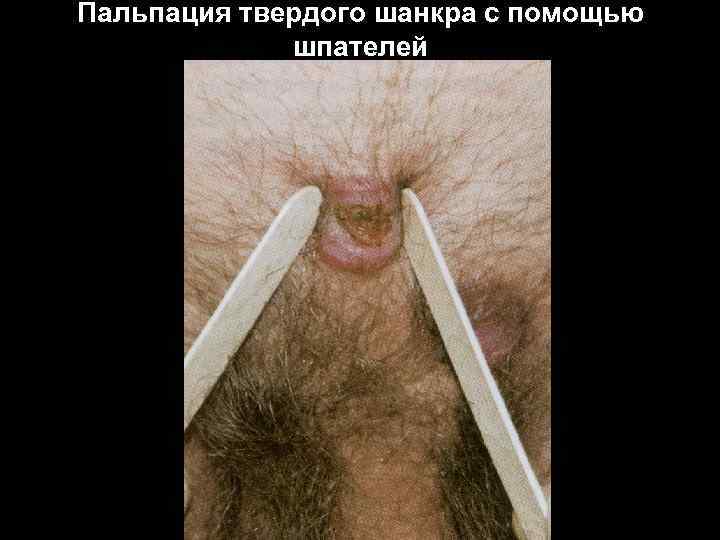 Пальпация твердого шанкра с помощью шпателей 