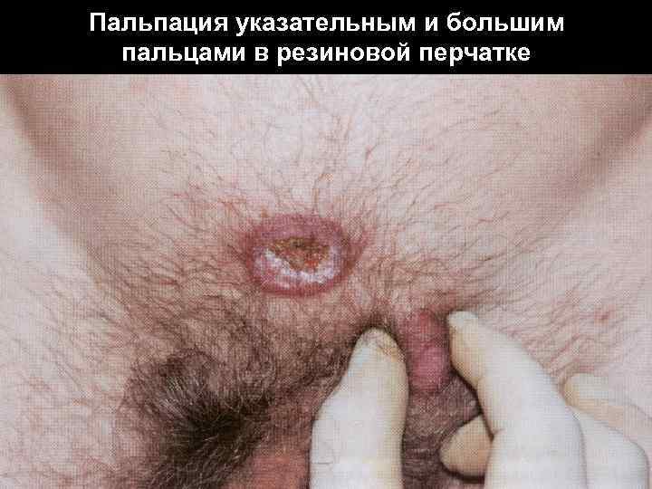Пальпация указательным и большим пальцами в резиновой перчатке 