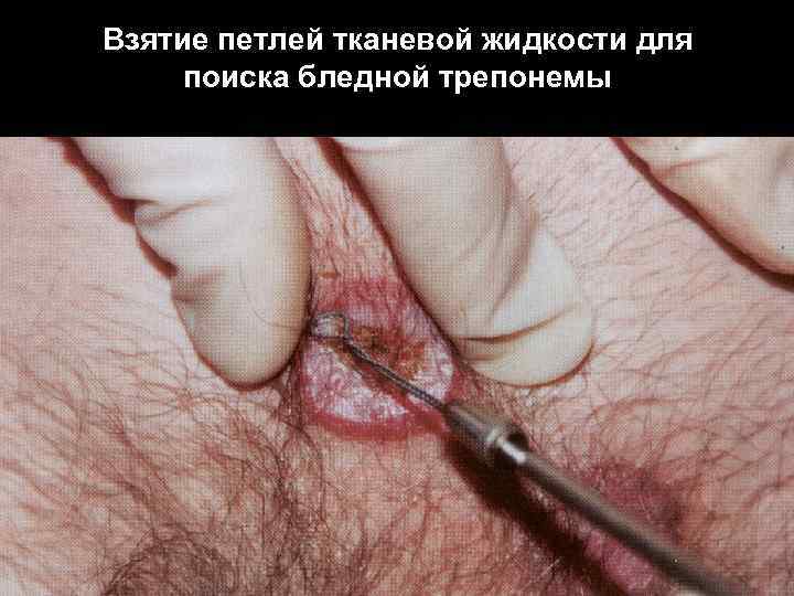 Взятие петлей тканевой жидкости для поиска бледной трепонемы 
