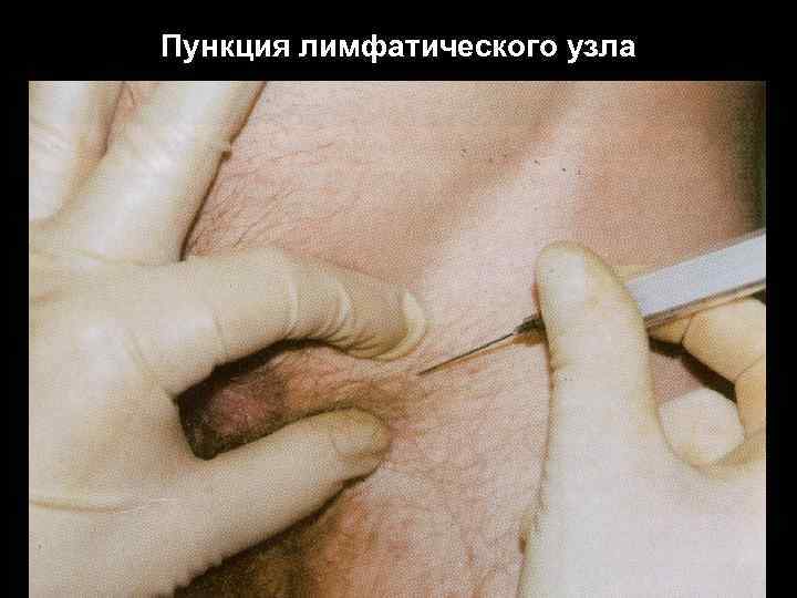 Пункция лимфатического узла 