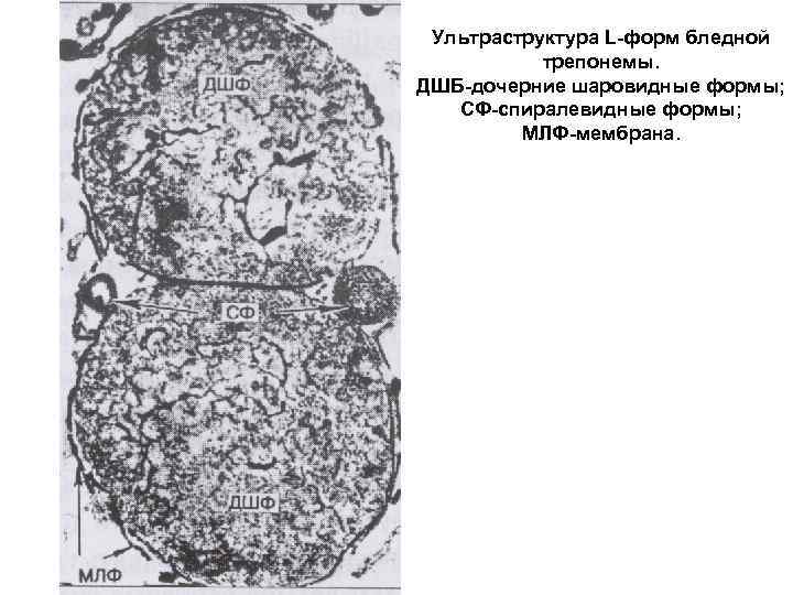 Ультраструктура L-форм бледной трепонемы. ДШБ-дочерние шаровидные формы; СФ-спиралевидные формы; МЛФ-мембрана. 
