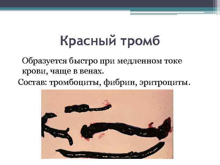 Красный тромб Образуется быстро при медленном токе крови, чаще в венах. Состав: тромбоциты, фибрин,