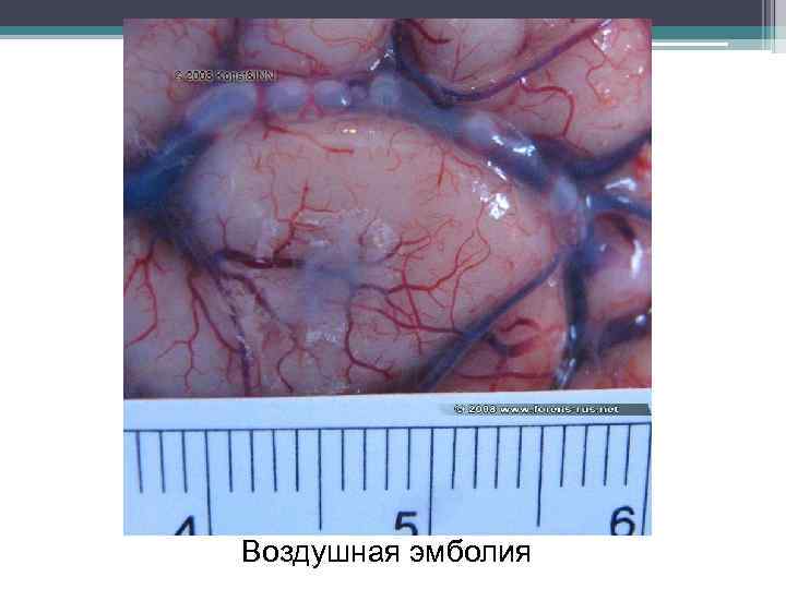 Воздушная эмболия 