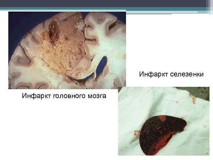 Инфаркт селезенки Инфаркт головного мозга 