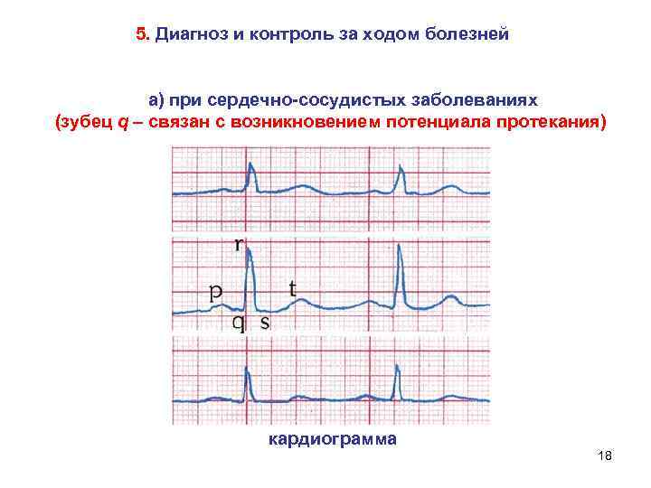 5. Диагноз и контроль за ходом болезней а) при сердечно-сосудистых заболеваниях (зубец q –