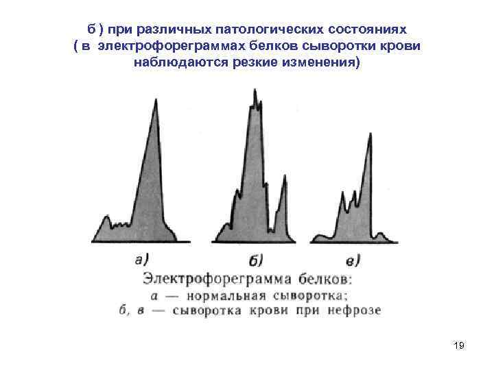 б ) при различных патологических состояниях ( в электрофореграммах белков сыворотки крови наблюдаются резкие