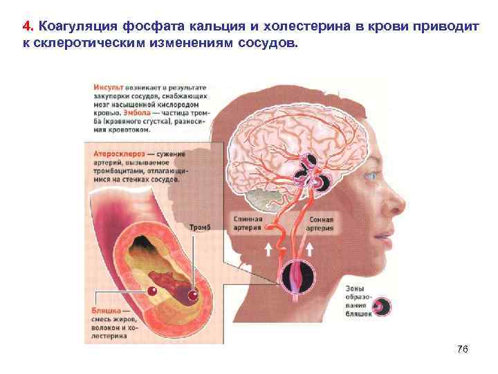 4. Коагуляция фосфата кальция и холестерина в крови приводит к склеротическим изменениям сосудов. 76