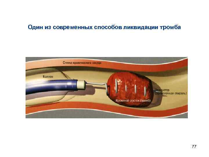 Один из современных способов ликвидации тромба 77 