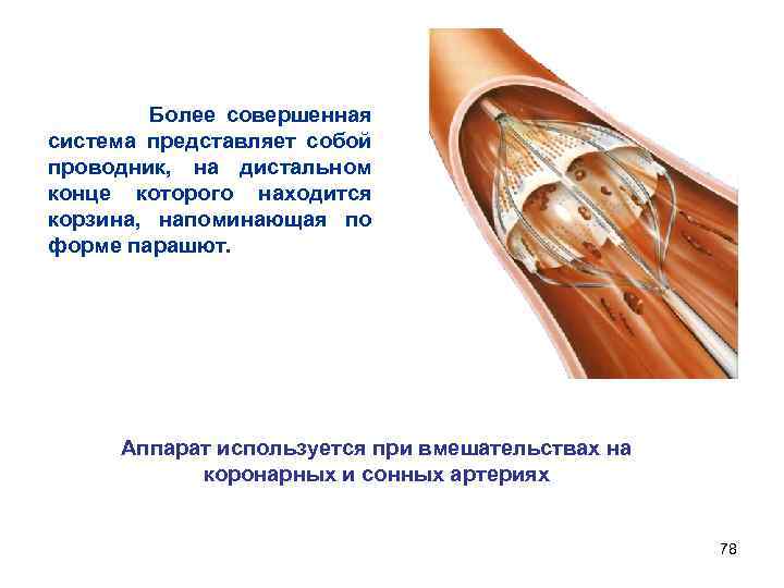 Более совершенная система представляет собой проводник, на дистальном конце которого находится корзина, напоминающая по