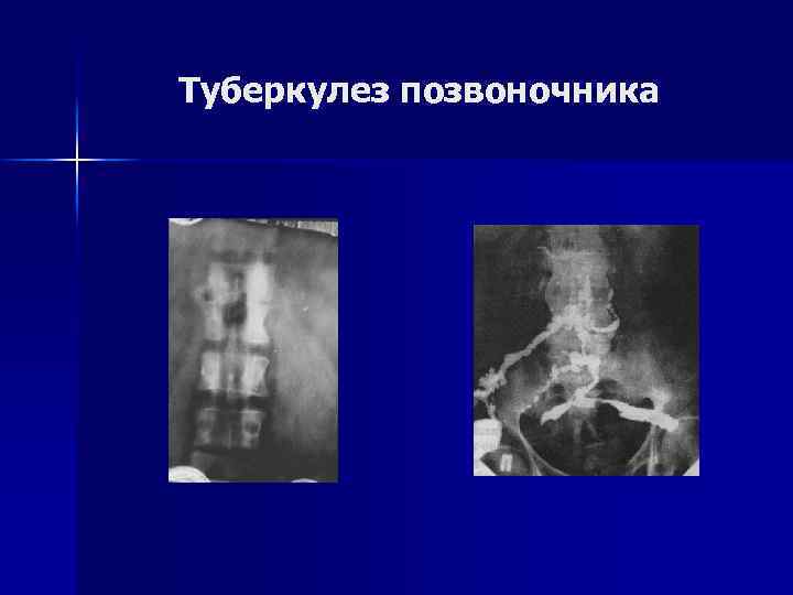 Туберкулез позвоночника 