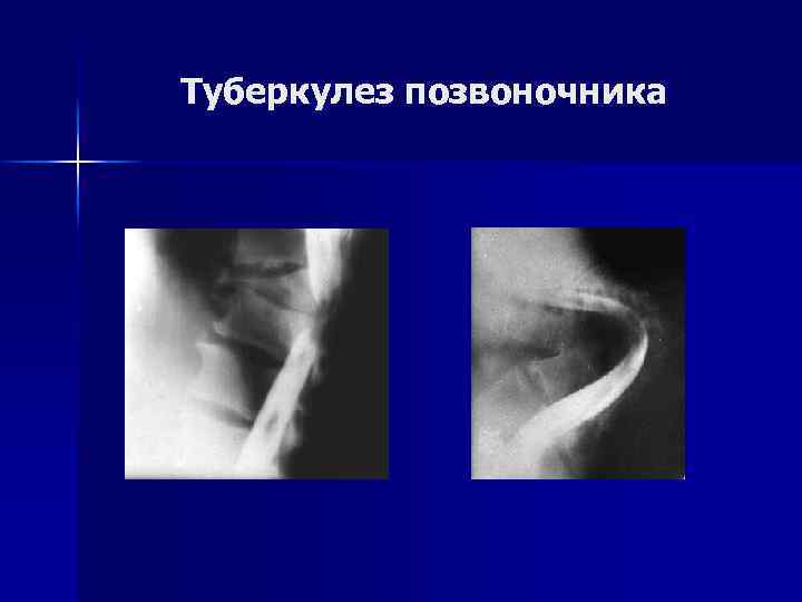 Туберкулез позвоночника 