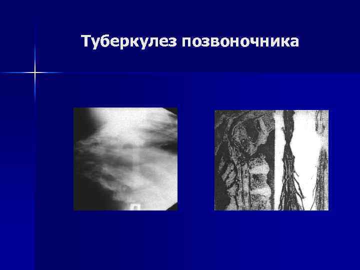 Туберкулез позвоночника 