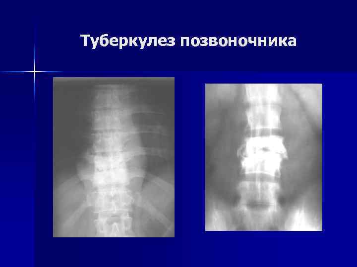Туберкулез позвоночника 