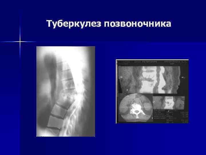 Туберкулез позвоночника 