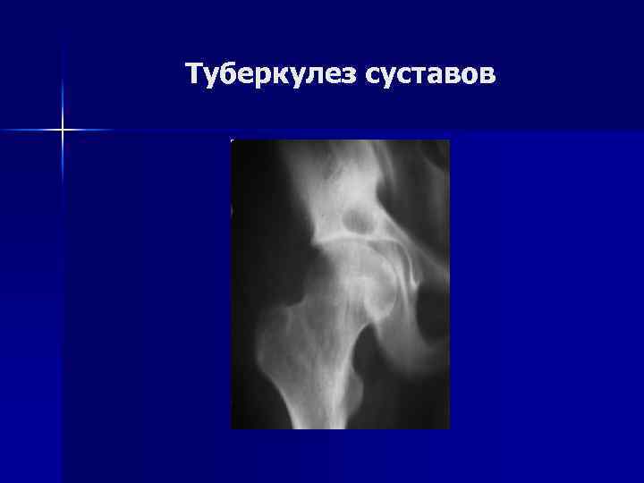 Туберкулез суставов 