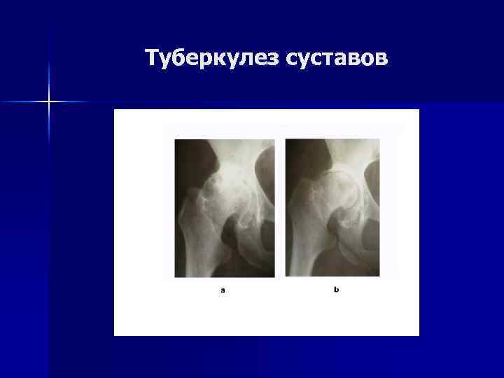 Туберкулез суставов 