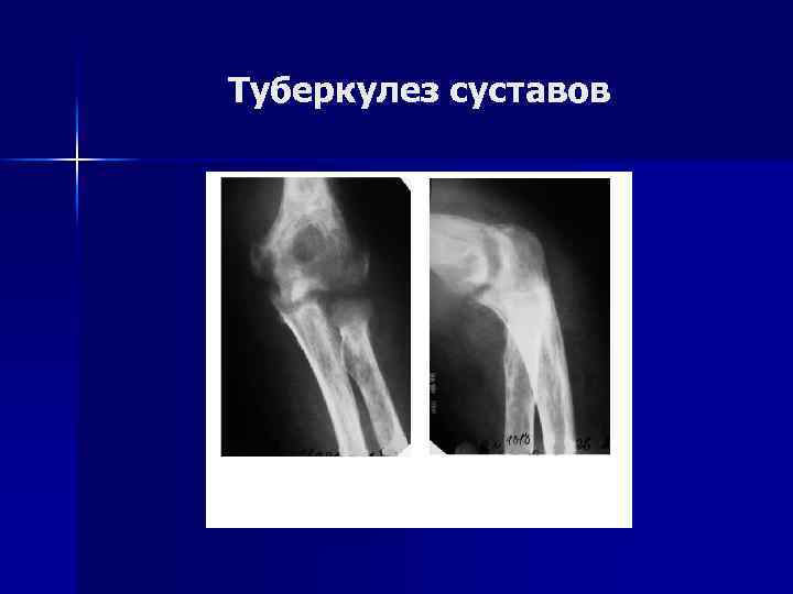 Туберкулез суставов 