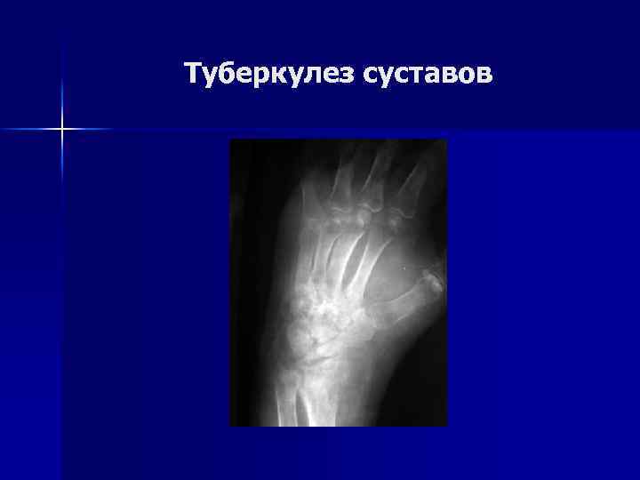 Туберкулез суставов 