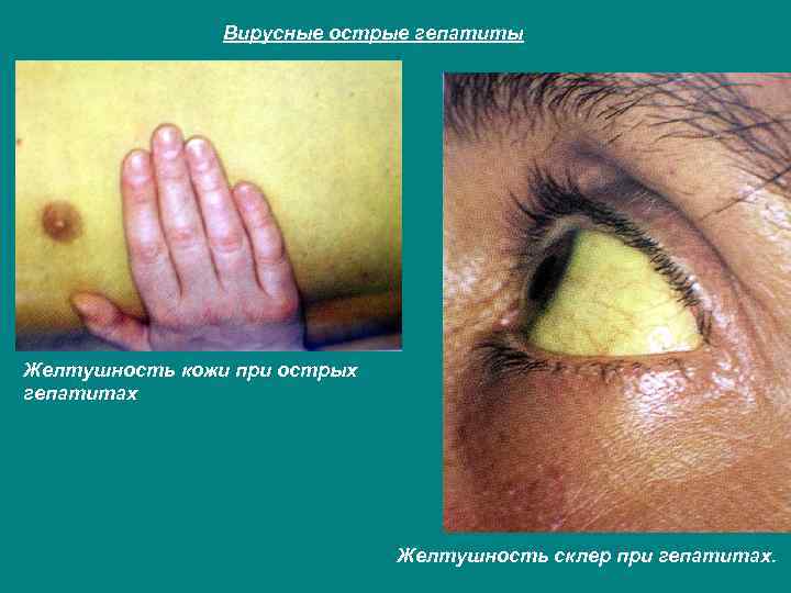Вирусные острые гепатиты Желтушность кожи при острых гепатитах Желтушность склер при гепатитах. 