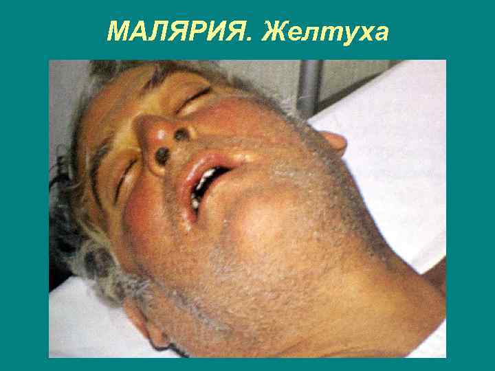 МАЛЯРИЯ. Желтуха 