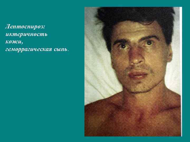 Лептоспироз: иктеричность кожи, геморрагическая сыпь. 