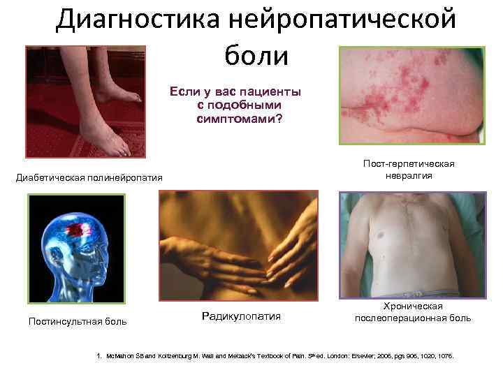 Диагностика нейропатической боли Если у вас пациенты с подобными симптомами? Пост-герпетическая невралгия Диабетическая полинейропатия