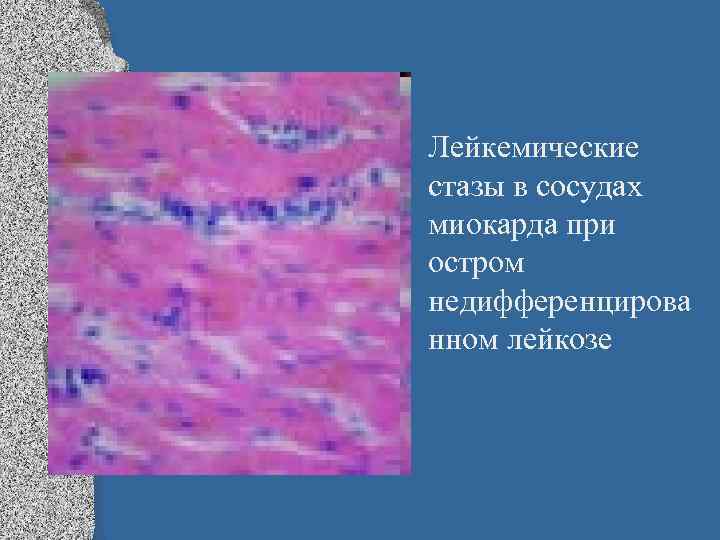  • Лейкемические стазы в сосудах миокарда при остром недифференцирова нном лейкозе 