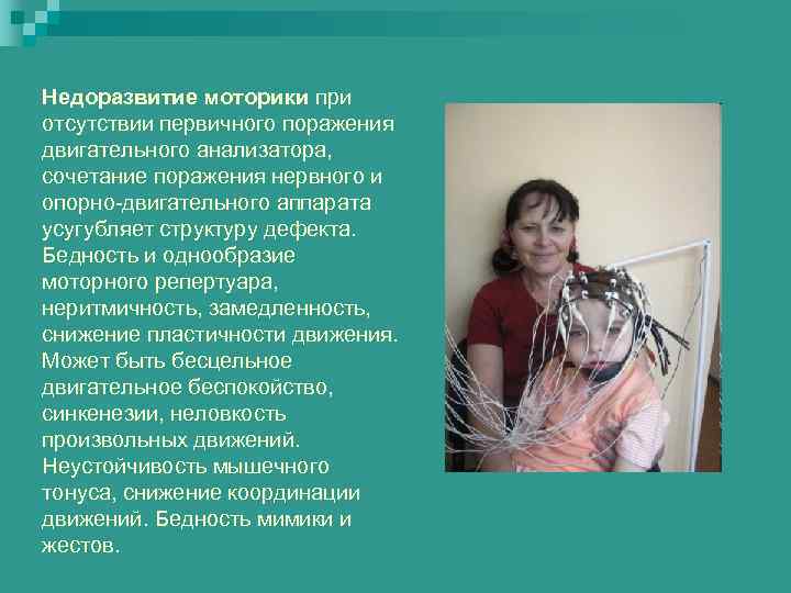 Недоразвитие моторики при отсутствии первичного поражения двигательного анализатора, сочетание поражения нервного и опорно-двигательного аппарата