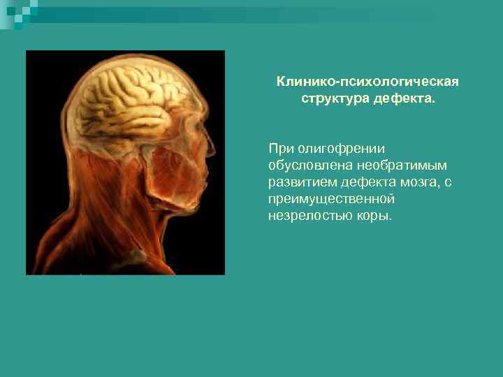 Недоразвитие зон мозга. Структура дефекта олигофрении. Мозг при олигофрении в анатомии.