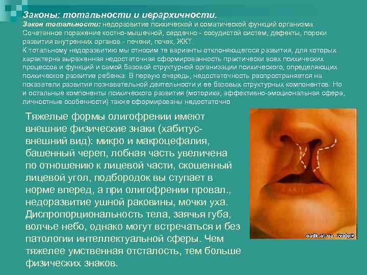 Законы: тотальности и иерархичности. Закон тотальности: недоразвитие психической и соматической функций организма. Сочетанное поражение