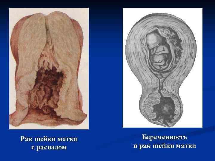 Рак шейки матки с распадом Беременность и рак шейки матки 