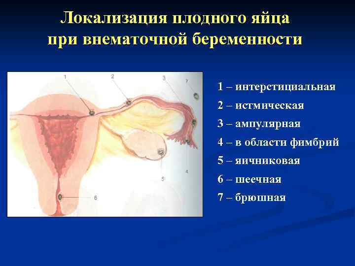 Локализация плодного яйца при внематочной беременности 1 – интерстициальная 2 – истмическая 3 –