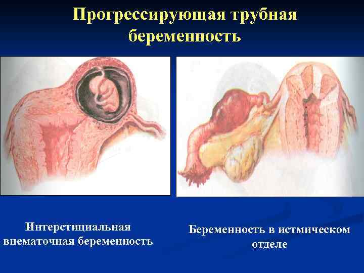 Прогрессирующая трубная беременность Интерстициальная внематочная беременность Беременность в истмическом отделе 