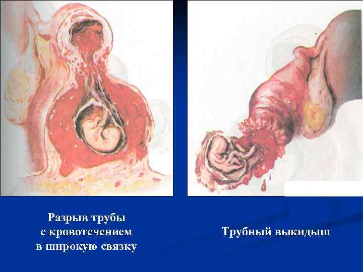 Разрыв трубы с кровотечением в широкую связку Трубный выкидыш 