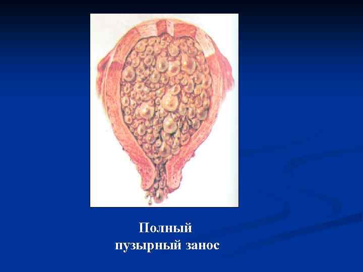 Полный пузырный занос 