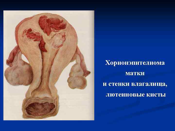 Хорионэпителиома матки и стенки влагалища, лютеиновые кисты 