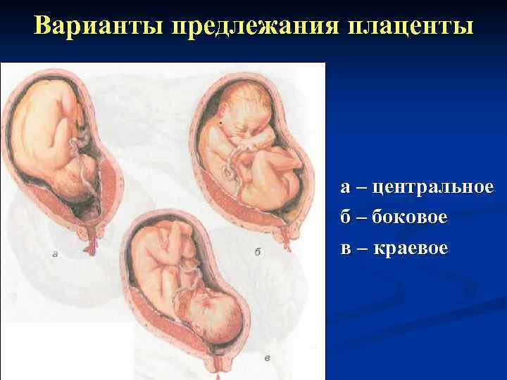 Варианты предлежания плаценты а – центральное б – боковое в – краевое 