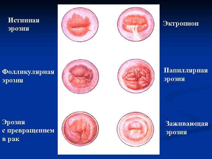 Истинная эрозия Эктропион Фолликулярная эрозия Папиллярная эрозия Эрозия с превращением в рак Заживающая эрозия