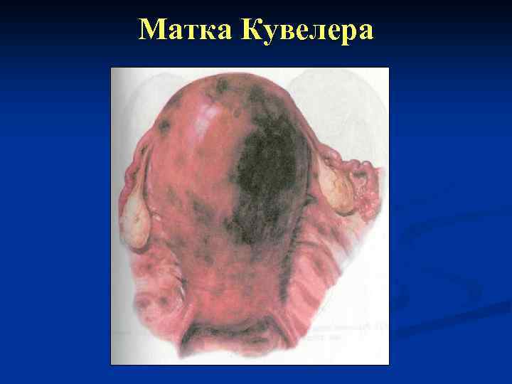 Матка Кувелера 