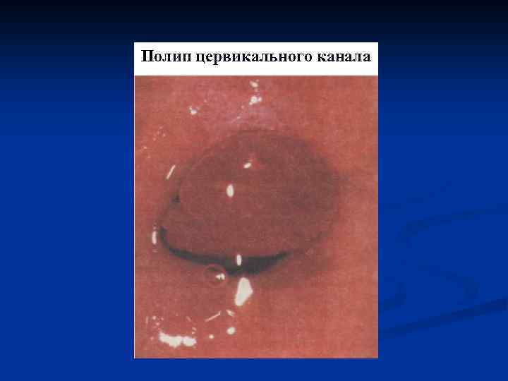 Полип цервикального канала 
