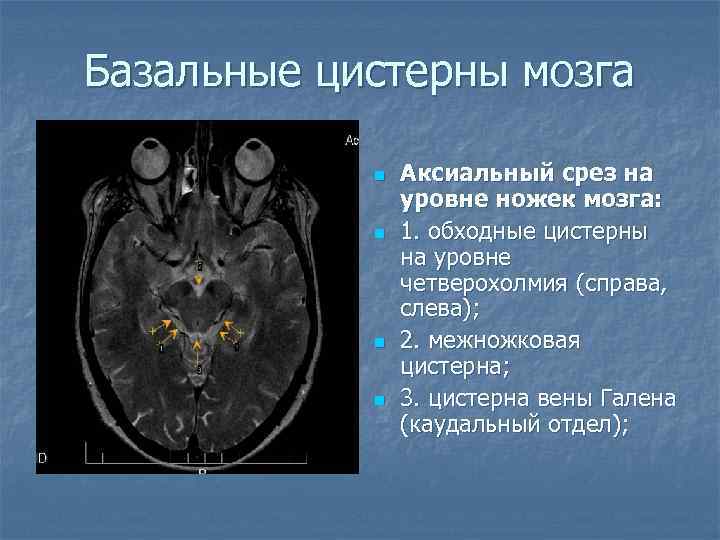 Базальные цистерны мозга n n Аксиальный срез на уровне ножек мозга: 1. обходные цистерны