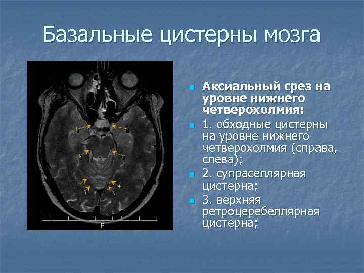 Базальные цистерны мозга n n Аксиальный срез на уровне нижнего четверохолмия: 1. обходные цистерны
