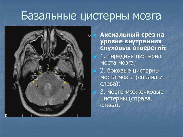 Базальные цистерны мозга n n Аксиальный срез на уровне внутренних слуховых отверстий: 1. передняя